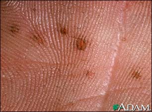 Basal cell nevus syndrome - close-up of palm Basal cell nevus syndrome - close-up of palm