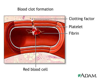 Blood clot formation Blood clot formation