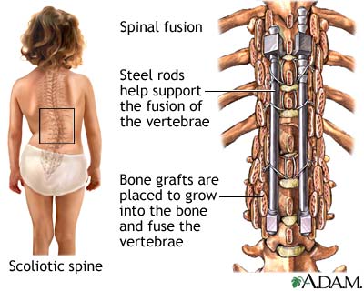 Spinal fusion Spinal fusion