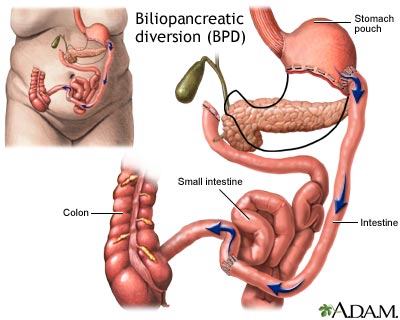 Biliopancreatic diversion (BPD) Biliopancreatic diversion (BPD)