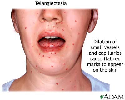 Telangiectasia Telangiectasia