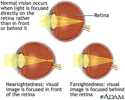 Normal, nearsightedness, and farsightedness Normal, nearsightedness, and farsightedness