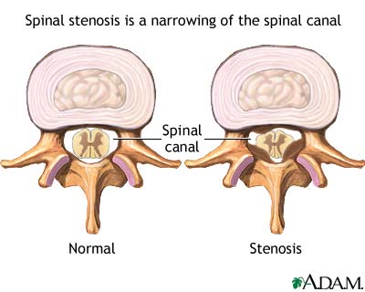 Spinal stenosis Spinal stenosis