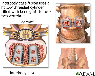 Interbody cage fusion