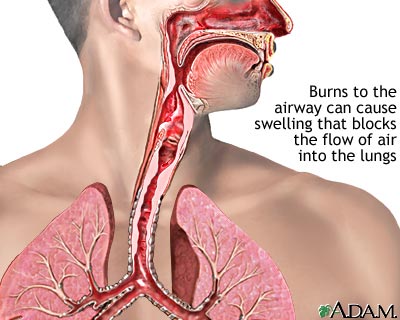 Airway burn Airway burn