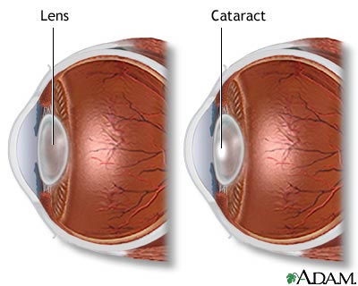 Cataract Cataract