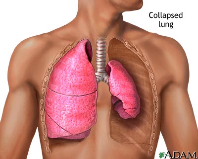 Collapsed lung, pneumothorax Collapsed lung, pneumothorax