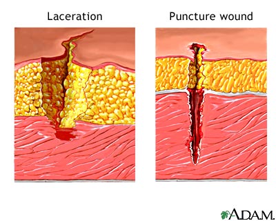 Laceration versus puncture wound Laceration versus puncture wound