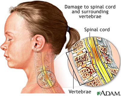 Spinal cord injury Spinal cord injury
