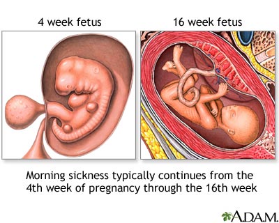 Morning sickness Morning sickness