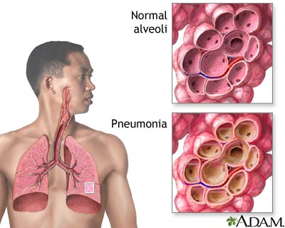 Pneumonia Pneumonia