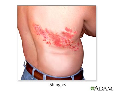 Shingles Shingles