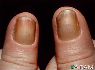 Yellow nail syndrome Yellow nail syndrome