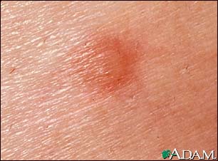 Flea bite - close-up Flea bite - close-up