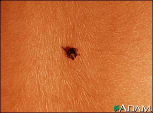 Tick imbedded in the skin Tick imbedded in the skin