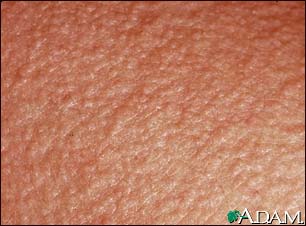 Miliaria profunda - close-up Miliaria profunda - close-up