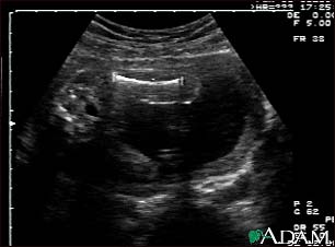 Ultrasound, normal fetus - femur measurement Ultrasound, normal fetus - femur measurement