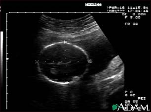 Ultrasound, normal fetus - head measurements Ultrasound, normal fetus - head measurements