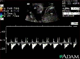 Ultrasound, normal fetus - heartbeat Ultrasound, normal fetus - heartbeat