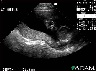 Ultrasound, normal relaxed placenta Ultrasound, normal relaxed placenta