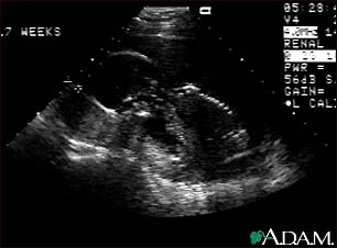 Ultrasound, normal fetus - profile view Ultrasound, normal fetus - profile view