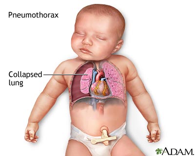 Pneumothorax