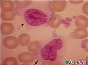Mononucleosis, photomicrograph of cell Mononucleosis, photomicrograph of cell