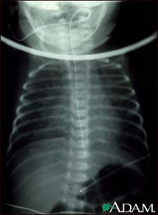 Totally anomalous pulmonary venous return, X-ray