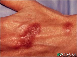 Mycobacterium marinum infection on the hand Mycobacterium marinum infection on the hand