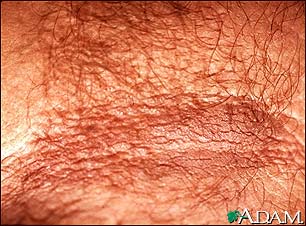 Acanthosis nigricans - close-up Acanthosis nigricans - close-up