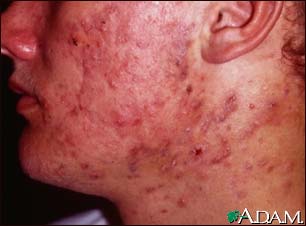 Acne, cystic on the face Acne, cystic on the face