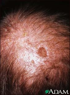 Actinic keratosis on the scalp Actinic keratosis on the scalp