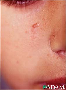 Tuberous sclerosis, angiofibromas - face Tuberous sclerosis, angiofibromas - face