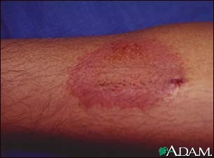 Dermatitis, contact Dermatitis, contact