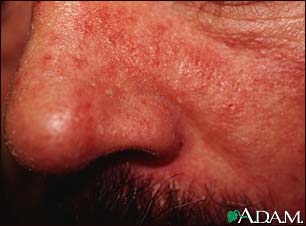 Dermatitis, seborrheic - close-up Dermatitis, seborrheic - close-up