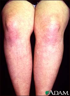 Dermatomyositis on the legs Dermatomyositis on the legs