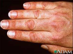 Dermatomyositis, Gottron's papule Dermatomyositis, Gottron's papule