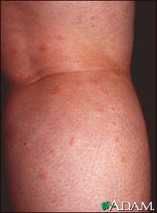 Insect bites on the legs Insect bites on the legs