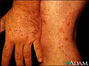 Ringworm, tinea on the hand and leg