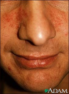 Rosacea Rosacea