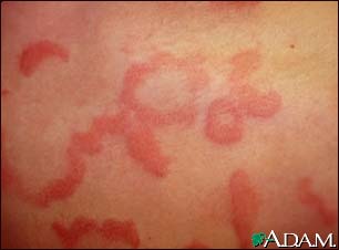 Hives (urticaria) - close-up Hives (urticaria) - close-up