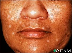 Vitiligo, drug induced Vitiligo, drug induced