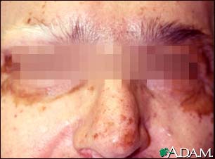 Vitiligo on the face Vitiligo on the face