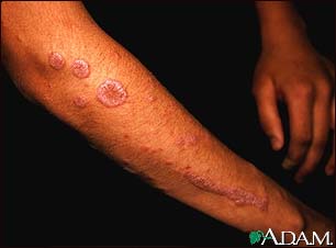 Lichen planus on the arm Lichen planus on the arm