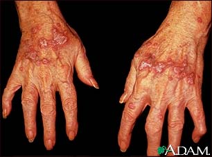 Lichen planus on the hands Lichen planus on the hands