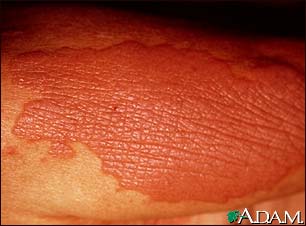 Lichen simplex chronicus