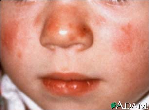 Lupus, discoid on a child's face Lupus, discoid on a child's face