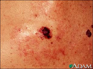 Skin cancer, close-up of level IV melanoma Skin cancer, close-up of level IV melanoma