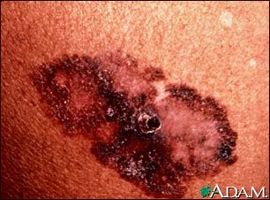Skin cancer, melanoma superficial spreading Skin cancer, melanoma superficial spreading