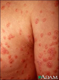 Psoriasis, guttate on the arms and chest Psoriasis, guttate on the arms and chest